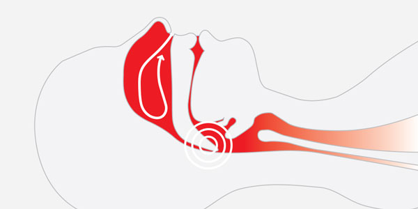 What Causes Snoring and How to Stop It